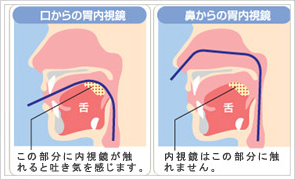 経鼻内視鏡検査について